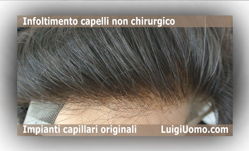 Trapianto Capelli Non Chirurgico Patch Cutanea